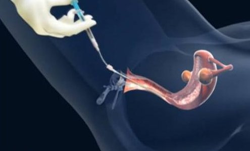 RFG试管婴儿治疗中，如何确保成功率最大化？